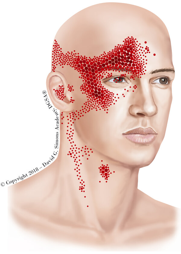 Referred pain pattern of the sternocleidomastoid muscle